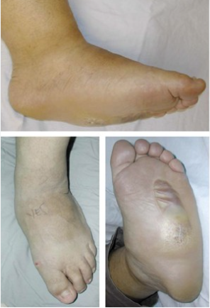 Charcot-Diabetic-Foot.webp