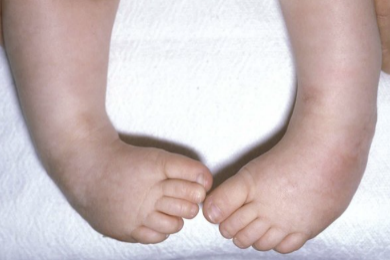 Club-Foot.webp