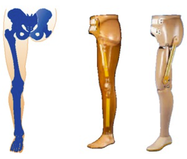 Hip-Disarticulation Prosthesis