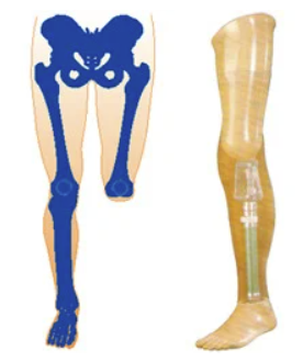 Knee-Disarticulation Prosthesis