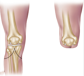 Knee-Disarticulation.webp