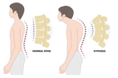 Normal Spine	  Kyphosis
