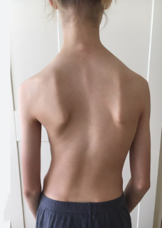 Scoliosis