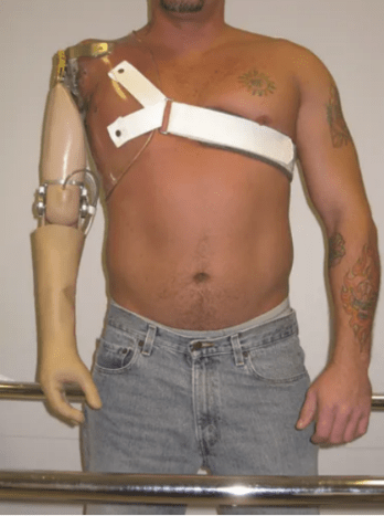 Shoulder Disarticulation