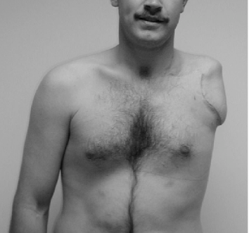 Shoulder Disarticulation