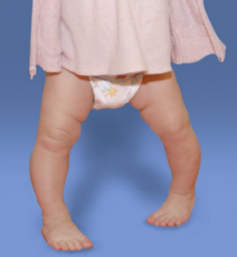 Genu Varum & In-toeing