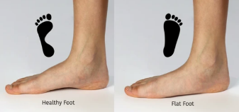 Flat Foot